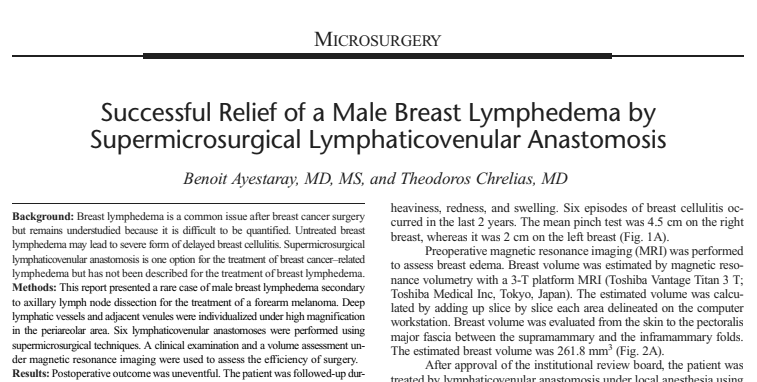 Successful Relief of a Male Breast Lymphedela by Supermicrosurgical Lymphaticovenular Anastomosis